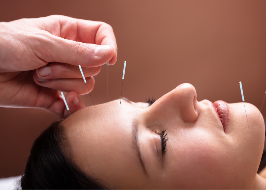 Facial Acupuncture